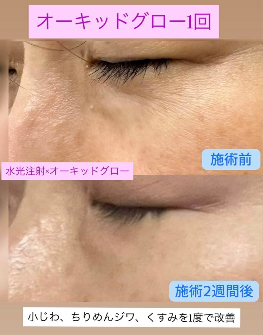 AM　オーキッドグロー×5本