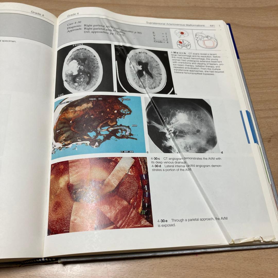 Color Atlas of Microneurosurgery 第2巻