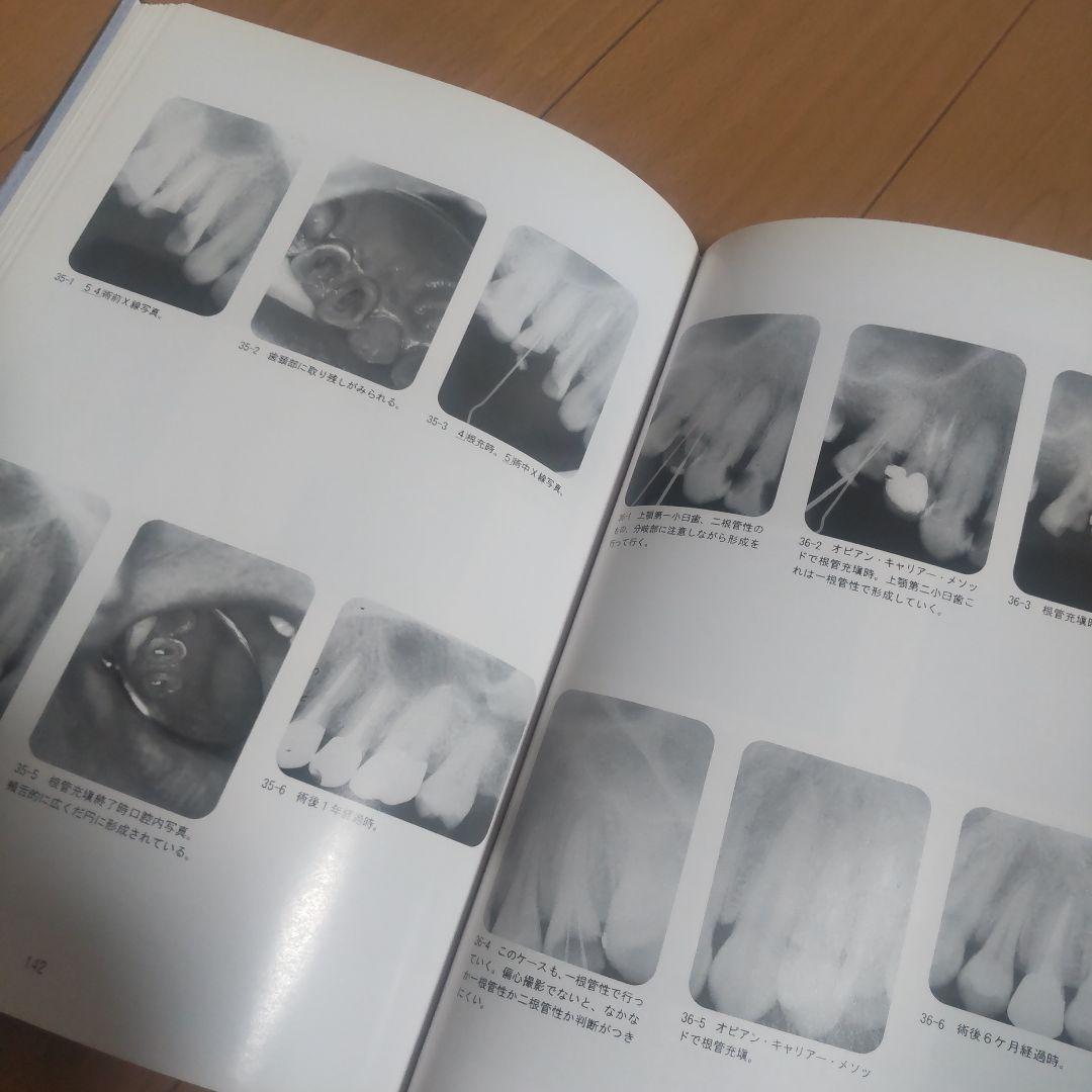 きがるな根管処置法   PARTー2