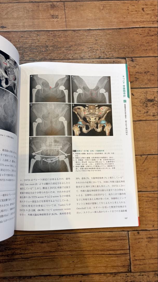 骨盤骨折　寛骨臼骨折・骨盤輪骨折の手術手技　整形外科
