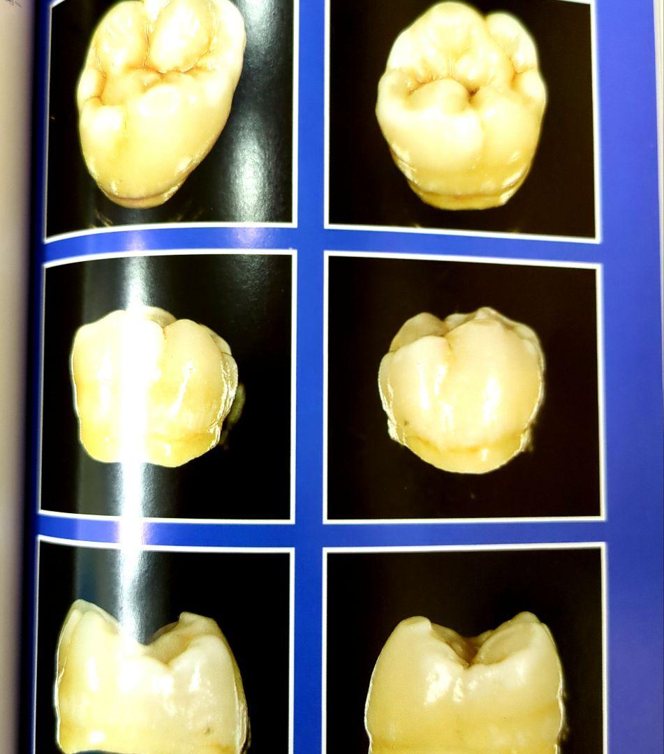 アナトミカル日歯咬合面形成法